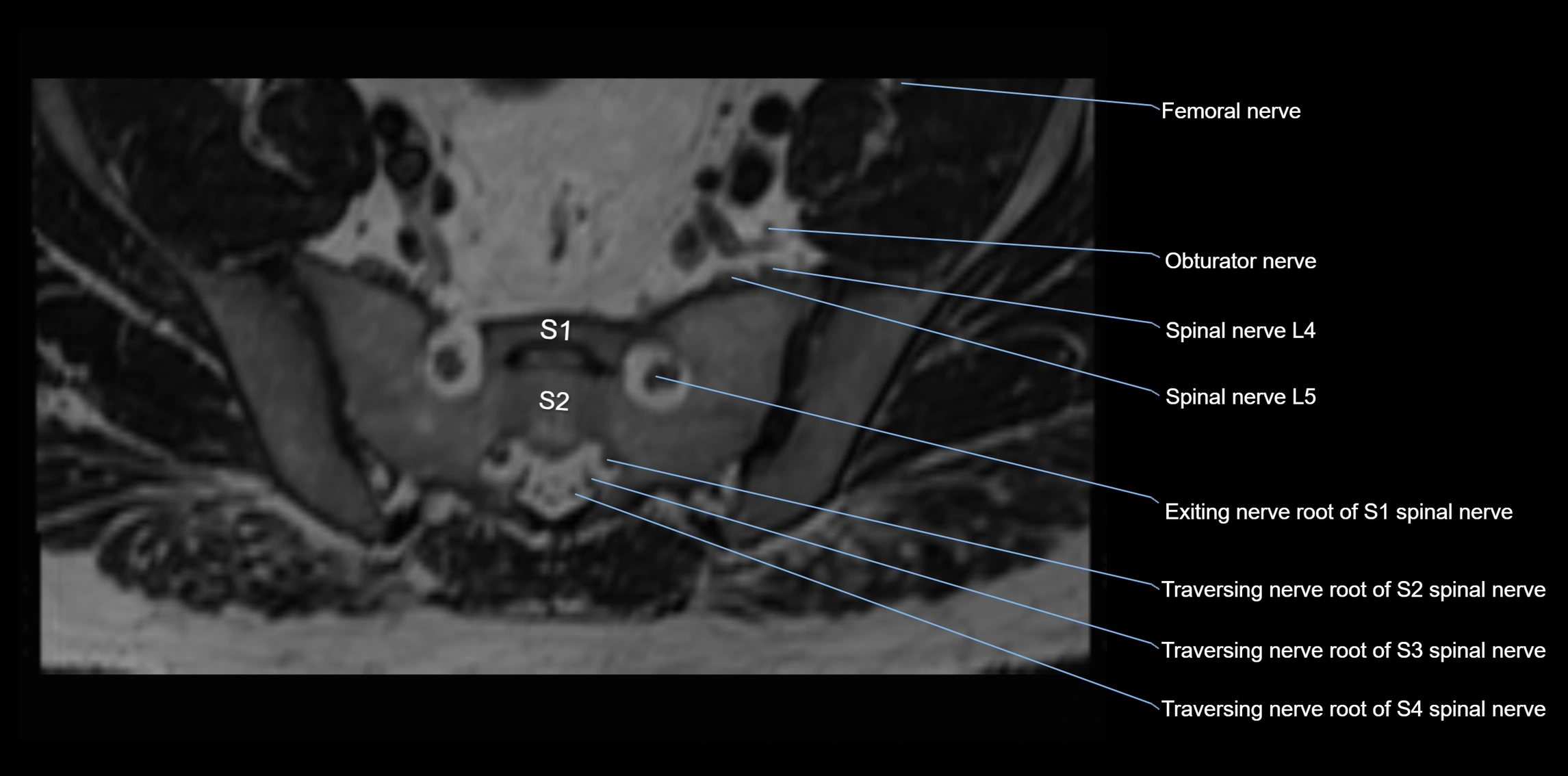 MR lumbosacral plexus axial cross sectional anatomy 3T  radiology  image-img-1008001-00080.webp